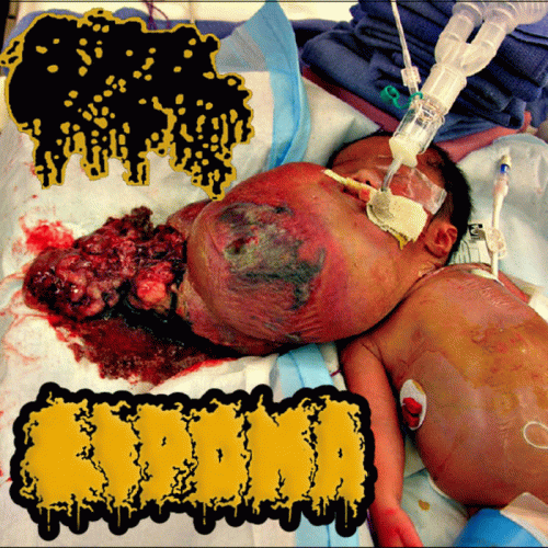 Lipoma : Lipoma - Calcified Fetus